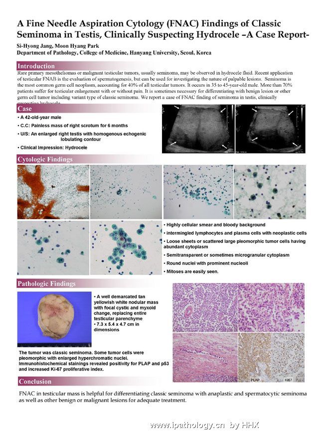 HYUH Poster. FNA Findings of Classic Seminoma in Testis图1