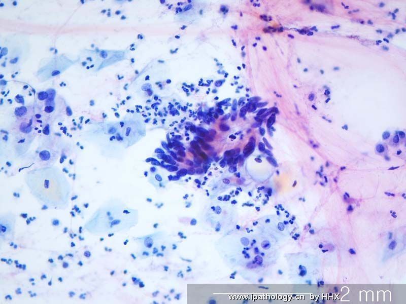 Teaching case(cervical cytology).What is your diagnosis?图7