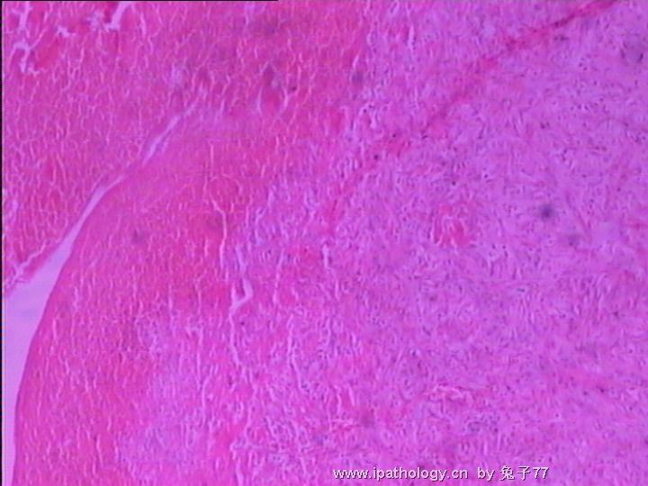 睾丸旁肿物(血管瘤??)－倾向于血肿机化图1