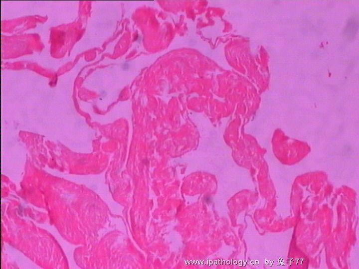 睾丸旁肿物(血管瘤??)－倾向于血肿机化图2