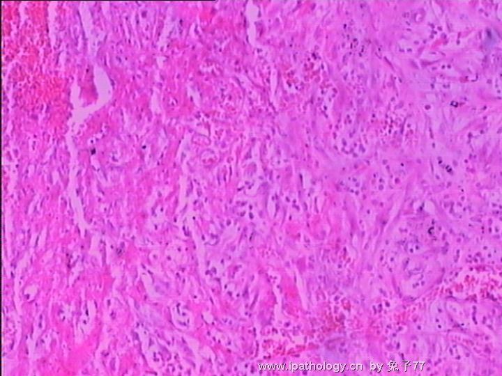 睾丸旁肿物(血管瘤??)－倾向于血肿机化图3
