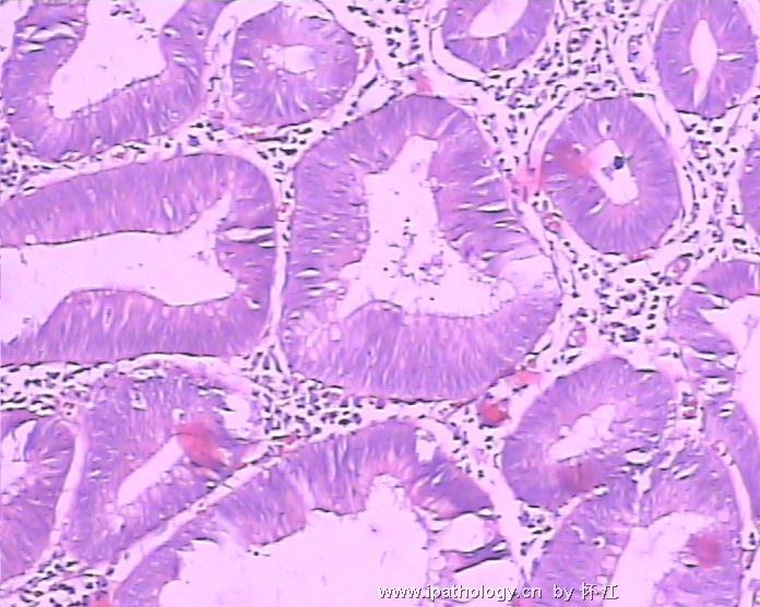 直肠肿瘤:腺瘤?高分化腺癌?图5