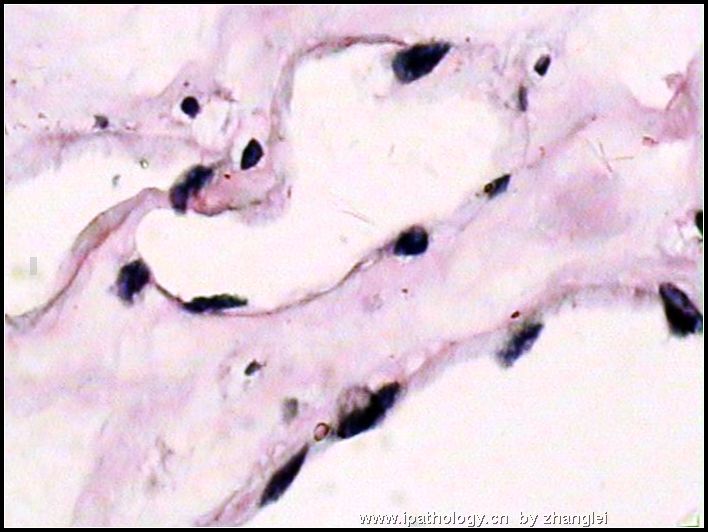 左肾上腺肿块－－ 血管瘤图8