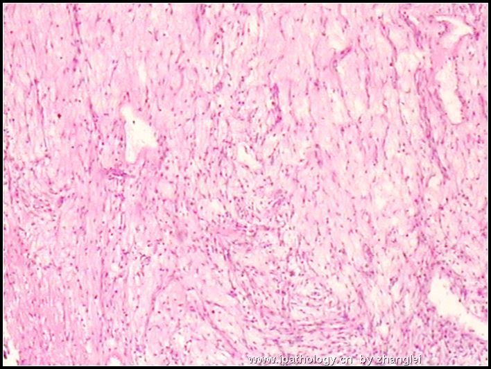 腹膜后肿块－－ 最后诊断：炎性肌纤维母细胞瘤图1