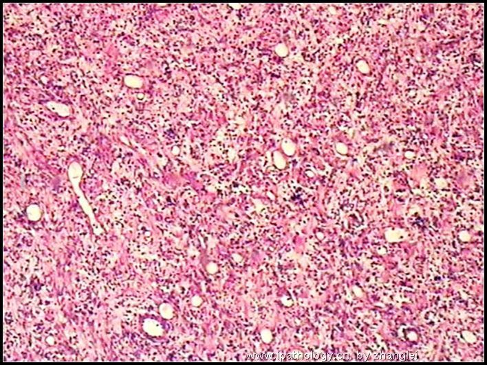 腹膜后肿块－－ 最后诊断：炎性肌纤维母细胞瘤图2