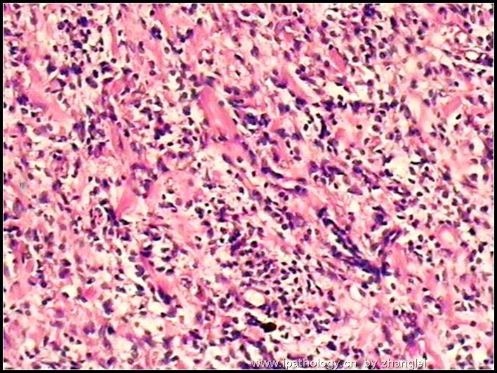 腹膜后肿块－－ 最后诊断：炎性肌纤维母细胞瘤图3