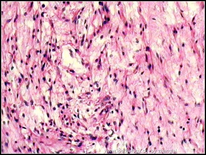 腹膜后肿块－－ 最后诊断：炎性肌纤维母细胞瘤图4