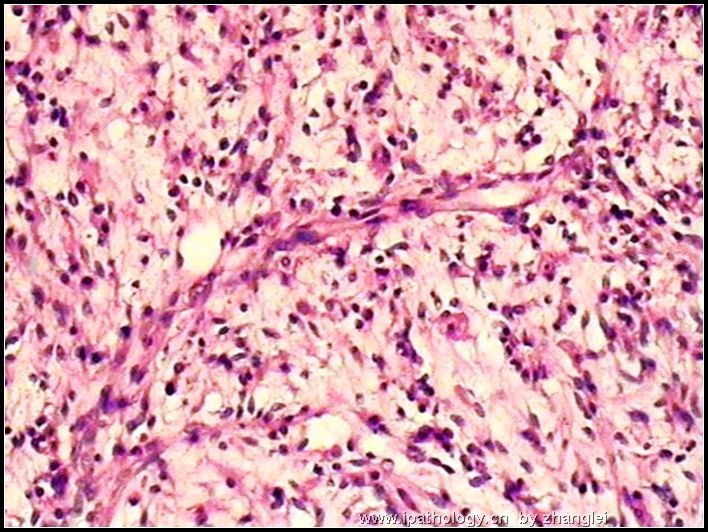 腹膜后肿块－－ 最后诊断：炎性肌纤维母细胞瘤图5
