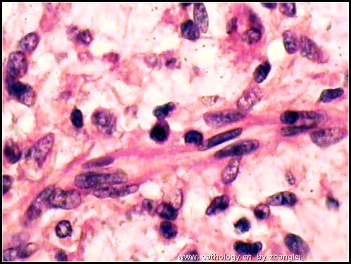 腹膜后肿块－－ 最后诊断：炎性肌纤维母细胞瘤图6