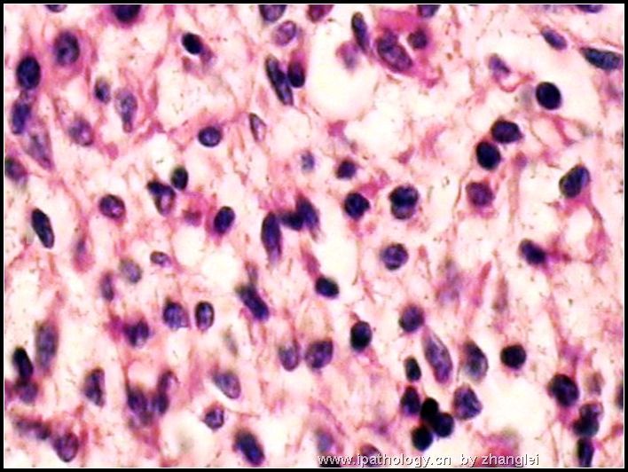 腹膜后肿块－－ 最后诊断：炎性肌纤维母细胞瘤图7