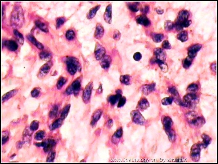 腹膜后肿块－－ 最后诊断：炎性肌纤维母细胞瘤图8