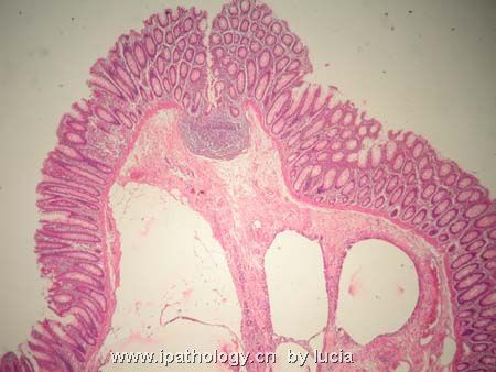 肠病变－pneumatosis cystoides intestinalis图1