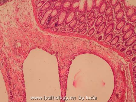 肠病变－pneumatosis cystoides intestinalis图2