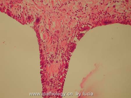 肠病变－pneumatosis cystoides intestinalis图3