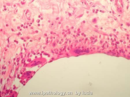 肠病变－pneumatosis cystoides intestinalis图4