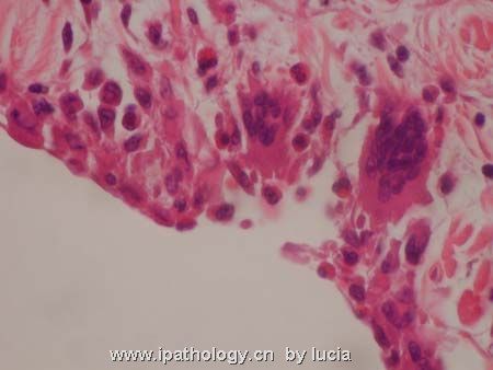 肠病变－pneumatosis cystoides intestinalis图5