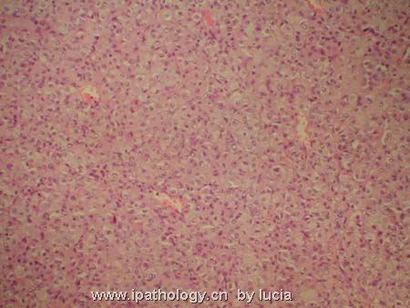 颅内肿瘤－introcranial meningeal melanocytoma图2