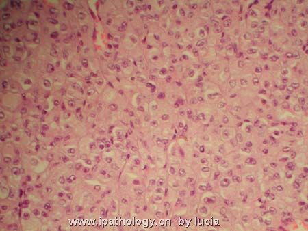 颅内肿瘤－introcranial meningeal melanocytoma图3