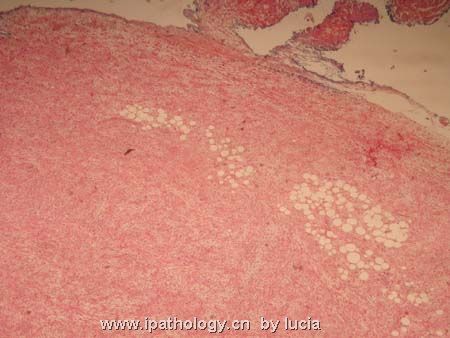 小腿肿物-myxofibrosarcoma图1