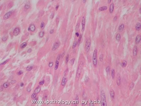 小腿肿物-myxofibrosarcoma图6