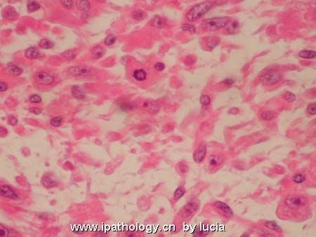 小腿肿物-myxofibrosarcoma图7
