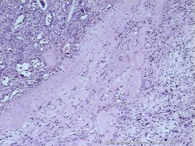 股骨肿瘤－－恶性骨巨细胞瘤图1
