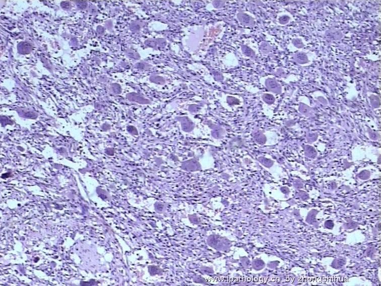 股骨肿瘤－－恶性骨巨细胞瘤图2