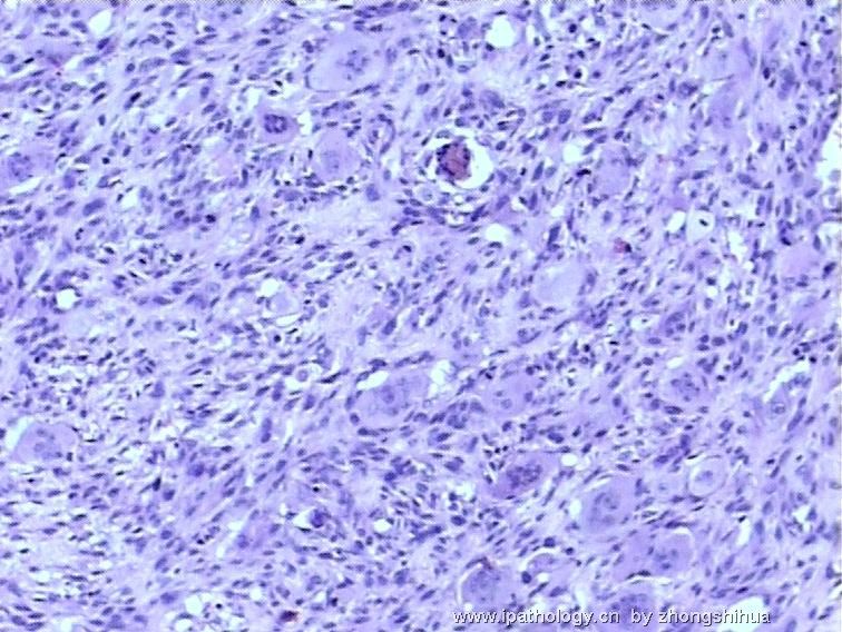 股骨肿瘤－－恶性骨巨细胞瘤图4