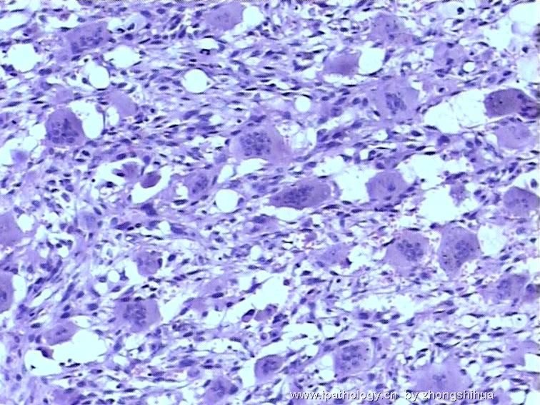 股骨肿瘤－－恶性骨巨细胞瘤图7