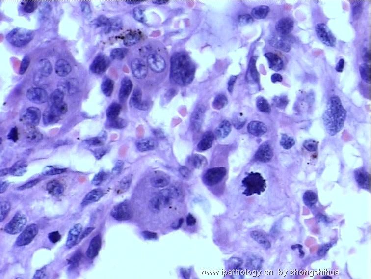 股骨肿瘤－－恶性骨巨细胞瘤图8