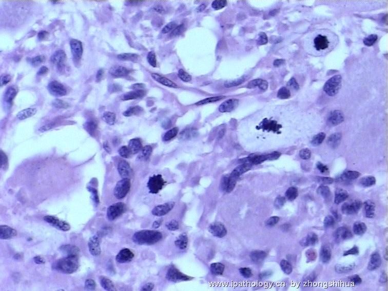 股骨肿瘤－－恶性骨巨细胞瘤图9