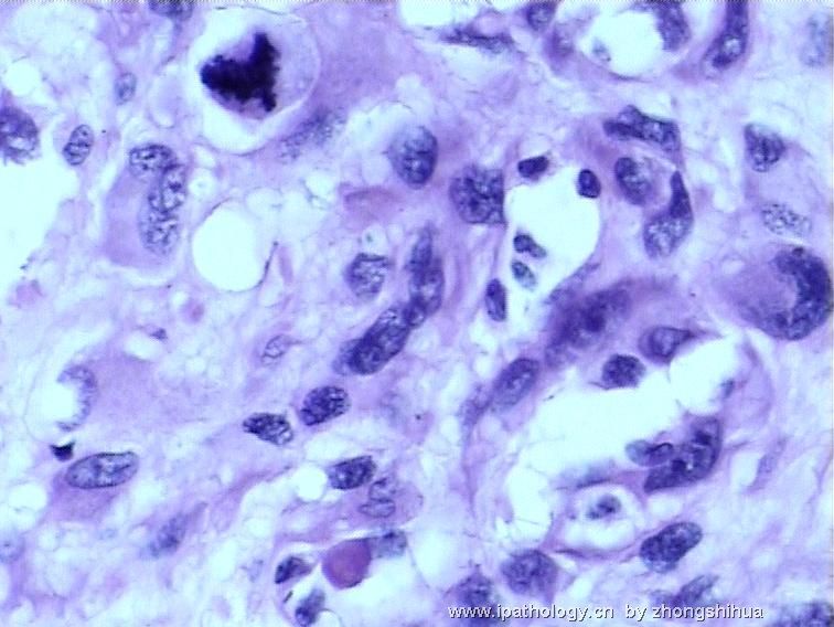 股骨肿瘤－－恶性骨巨细胞瘤图11