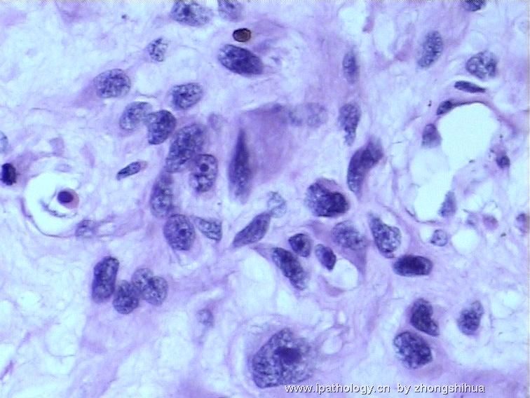股骨肿瘤－－恶性骨巨细胞瘤图12
