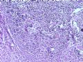 乳腺肿瘤－－结外NK/T细胞淋巴瘤图3