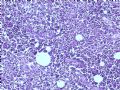 乳腺肿瘤－－结外NK/T细胞淋巴瘤图6