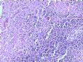 乳腺肿瘤－－结外NK/T细胞淋巴瘤图7