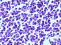 乳腺肿瘤－－结外NK/T细胞淋巴瘤图8