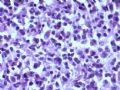 乳腺肿瘤－－结外NK/T细胞淋巴瘤图9