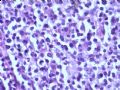 乳腺肿瘤－－结外NK/T细胞淋巴瘤图10
