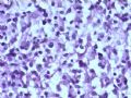 乳腺肿瘤－－结外NK/T细胞淋巴瘤图11