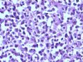 乳腺肿瘤－－结外NK/T细胞淋巴瘤图12