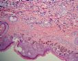 肛周肿块--促结缔组织增生性小圆细胞肿瘤（DSRCT）图1