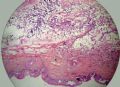 肛周肿块--促结缔组织增生性小圆细胞肿瘤（DSRCT）图2