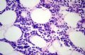 肛周肿块--促结缔组织增生性小圆细胞肿瘤（DSRCT）图4