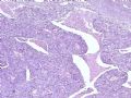 腹部肿块--胰母细胞瘤图1