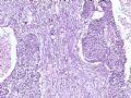 腹部肿块--胰母细胞瘤图6