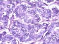 腹部肿块--胰母细胞瘤图7