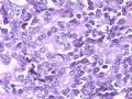 腹部肿块--胰母细胞瘤图8