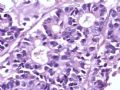腹部肿块--胰母细胞瘤图9