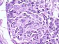 腹部肿块--胰母细胞瘤图10